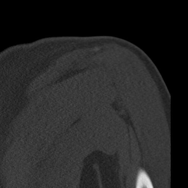 File:Bankart lesion (Radiopaedia 22771-22798 Coronal bone window 40).jpg