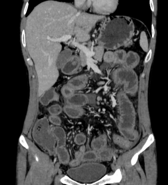 File:Behçet's disease- abdominal vasculitis (Radiopaedia 55955-62570 B 19).jpg