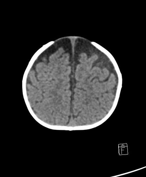 File:Benign enlargement of subarachnoid spaces in infancy (BESS) (Radiopaedia 87459-103795 Axial non-contrast 18).jpg