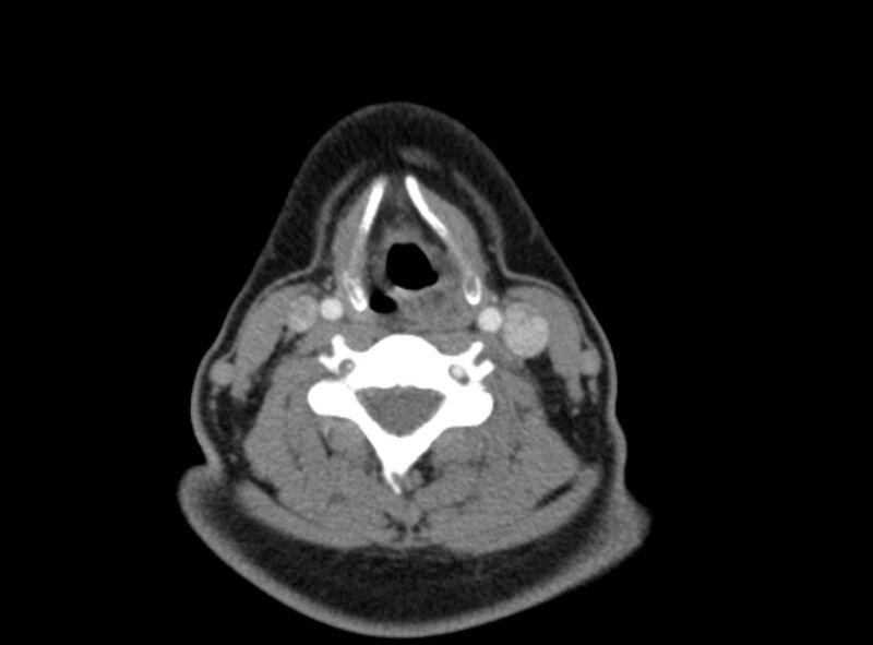 File:Benign mixed salivary tumor of the parotid gland (Radiopaedia 35261-36792 A 33).jpg