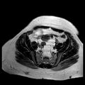 Benign seromucinous cystadenoma of the ovary (Radiopaedia 71065-81300 B 12).jpg