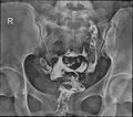 Bicornuate vs septate uterus (Radiopaedia 62784-71120 H 1).jpg