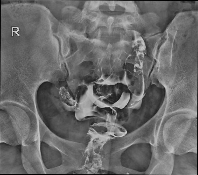 File:Bicornuate vs septate uterus (Radiopaedia 62784-71120 H 1).jpg