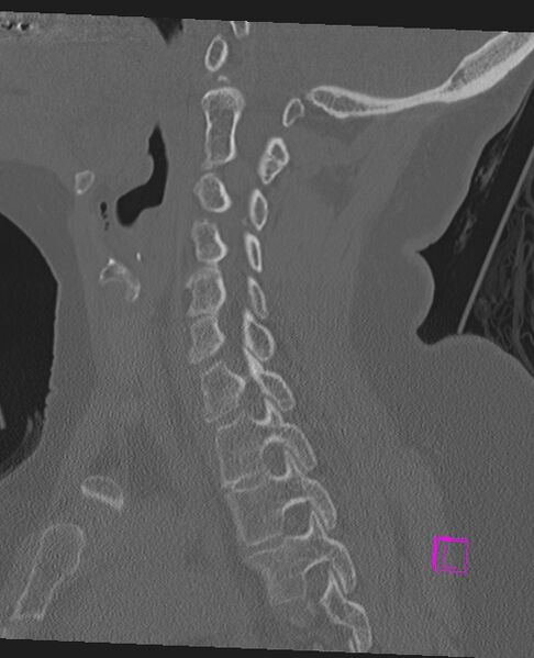 File:Bilateral atlanto-occipital assimilation (Radiopaedia 28350-28603 Sagittal bone window 33).jpg