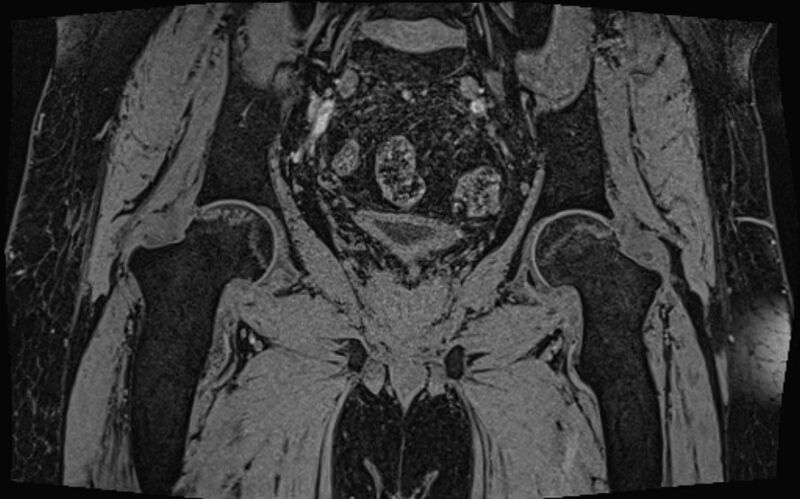 File:Bilateral avascular necrosis of femoral head (Radiopaedia 77116-89078 Coronal T2 we 31).jpg