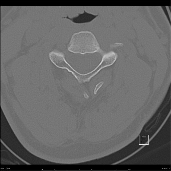 File:Bilateral cervical ribs (Radiopaedia 25868-26017 Axial bone window 21).jpg