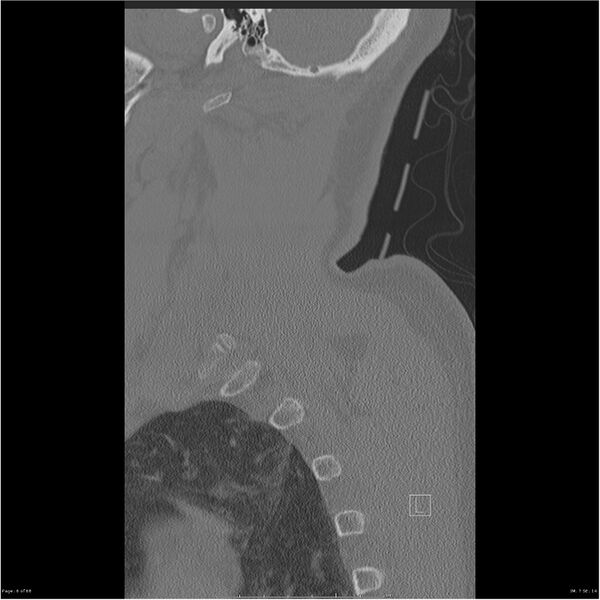 File:Bilateral cervical ribs (Radiopaedia 25868-26017 Sagittal bone window 6).jpg