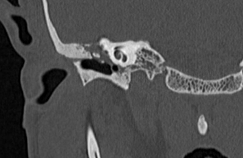 File:Bilateral cholesteatoma (Radiopaedia 54898-61172 Coronal bone window 29).jpg