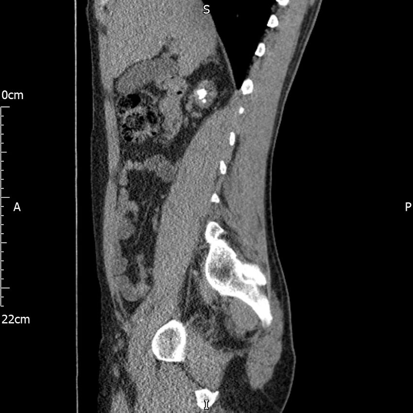 Bilateral medullary nephrocalcinosis with ureteric calculi (Radiopaedia 71269-81569 C 74).jpg