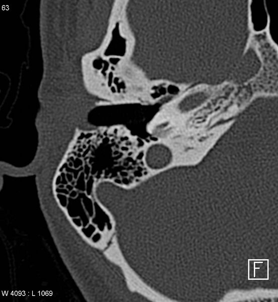 File:Bilateral otosclerosis with left stapes prosthesis (Radiopaedia 5567-7302 Axial bone window 1).jpg
