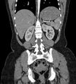 Bilateral ovarian mature cystic teratomas (Radiopaedia 79373-92457 B 63).jpg