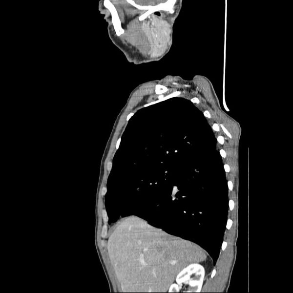 File:Bilateral parotid gland lymphoma (Radiopaedia 21038-20969 C 14).jpg
