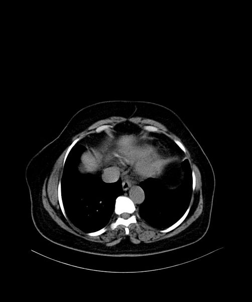 File:Bilateral sporadic synchronous clear cell renal cell carcinoma (Radiopaedia 85035-100572 Axial non-contrast 3).jpg