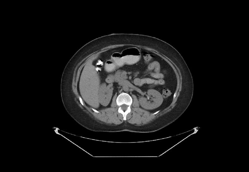 File:Bilateral urolithiasis with incidentally detected splenic artery aneurysm and left inferior vena cava (Radiopaedia 44467-48123 Axial non-contrast 19).jpg
