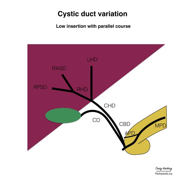 File:Biliary duct anatomic variation (diagram) (Radiopaedia 70380-80479 Cystic duct 3).jpeg