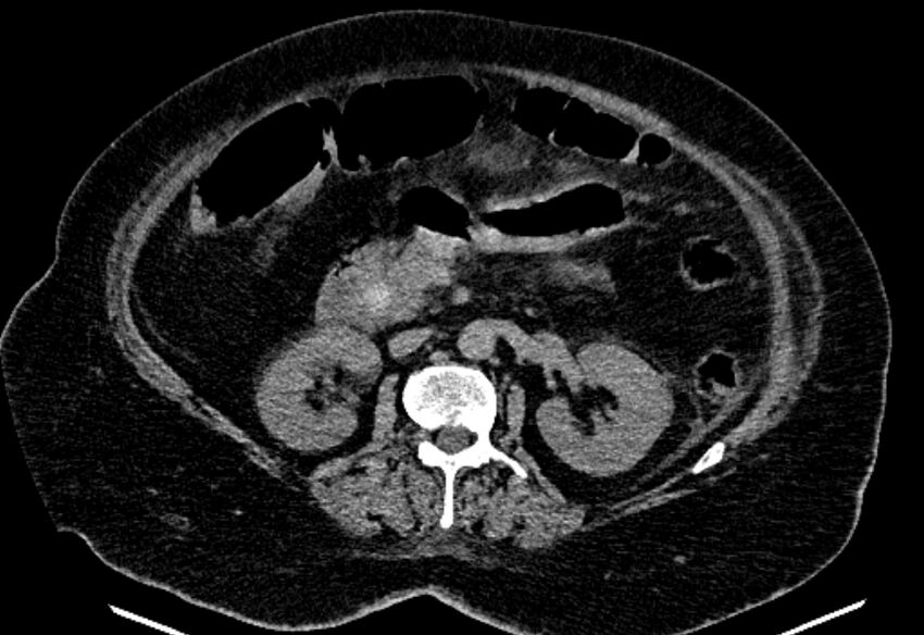 Biliary pancreatitis (Radiopaedia 72289-82823 Axial non-contrast 119).jpg