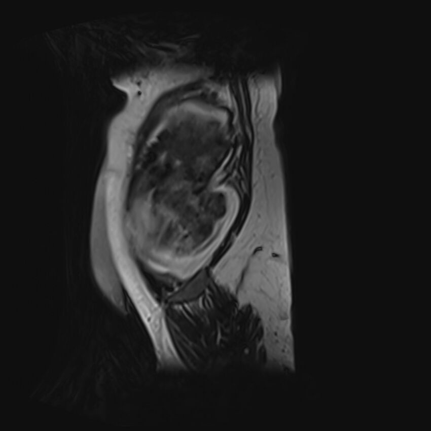 Bilobed placenta accreta (Radiopaedia 69648-79591 G 58).jpg