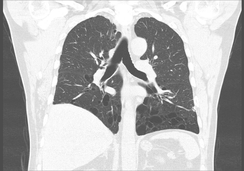 File:Birt-Hogg-Dubé syndrome (Radiopaedia 52578-58491 Coronal lung window 34).jpg