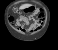 Bladder papillary urothelial carcinoma (Radiopaedia 48119-52951 C 12).png