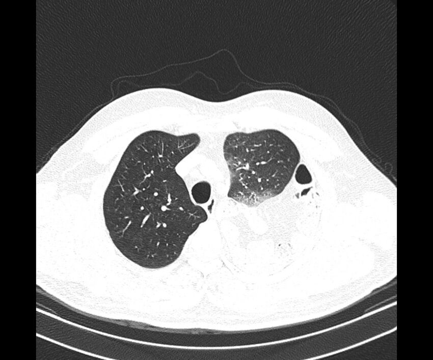 Bochdalek hernia - adult presentation (Radiopaedia 74897-85925 Axial lung window 10).jpg