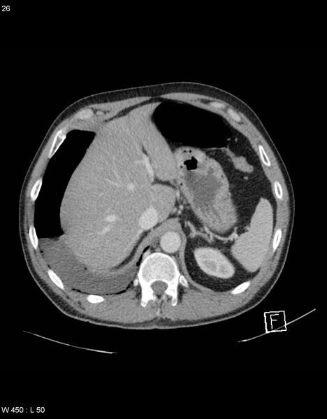 File:Boerhaave syndrome with tension pneumothorax (Radiopaedia 56794-63603 A 13).jpg