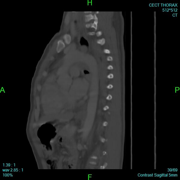 File:Bone metastases from lung carcinoma (Radiopaedia 54703-60937 Sagittal bone window 39).jpg