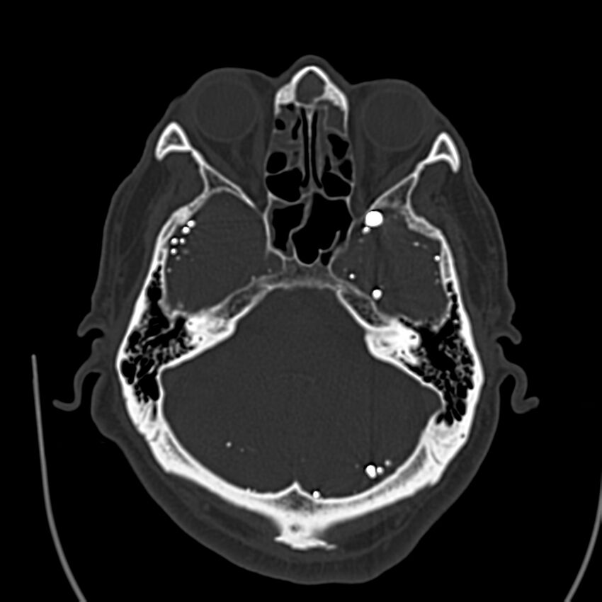Brain Pantopaque remnants (Radiopaedia 78403-91048 Axial bone window 24).jpg