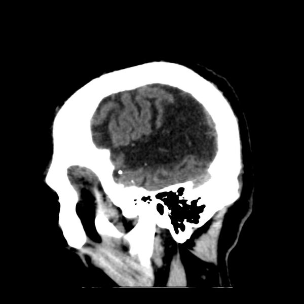File:Brain Pantopaque remnants (Radiopaedia 78403-91048 C 9).jpg