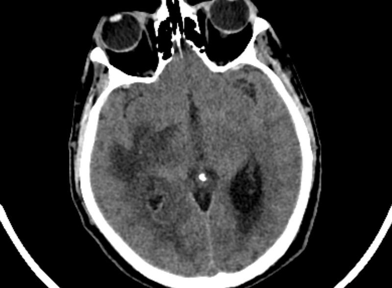 File:Brain abscess complicated by intraventricular rupture and ventriculitis (Radiopaedia 82434-96575 Axial non-contrast 30).jpg