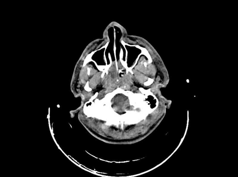 File:Brain injury by firearm projectile (Radiopaedia 82068-96087 B 46).jpg