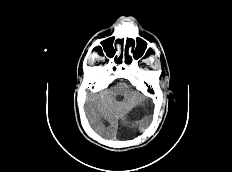 File:Brain injury by firearm projectile (Radiopaedia 82068-96088 A 94).jpg
