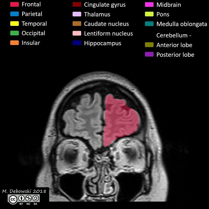 Brain lobes - annotated MRI (Radiopaedia 61691-69700 Coronal 6).JPG