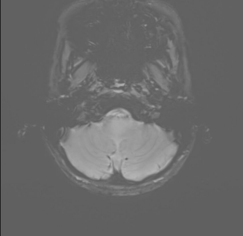Brainstem glioma (Radiopaedia 70548-80674 Axial SWI 3).jpg