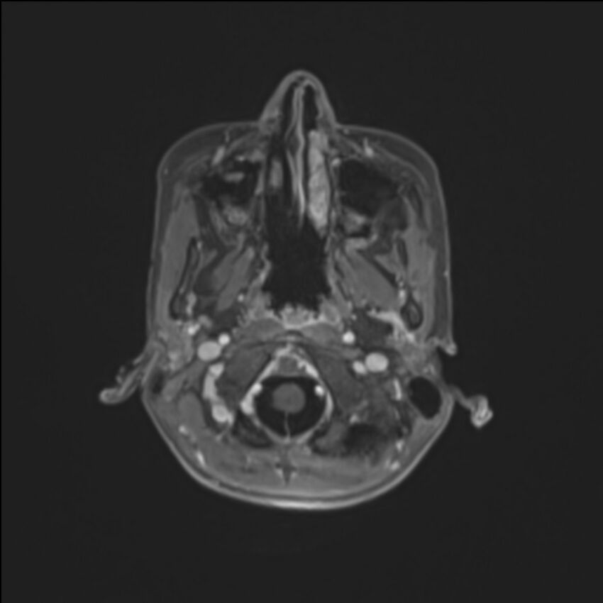 Brainstem glioma (Radiopaedia 70548-80674 Axial T1 C+ 19).jpg
