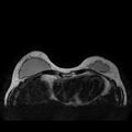Breast implants - MRI (Radiopaedia 26864-27035 Axial T2 11).jpg