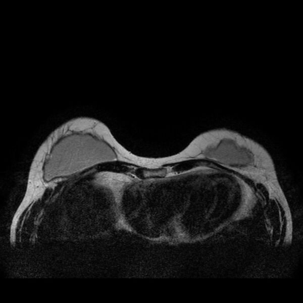 File:Breast implants - MRI (Radiopaedia 26864-27035 Axial T2 11).jpg