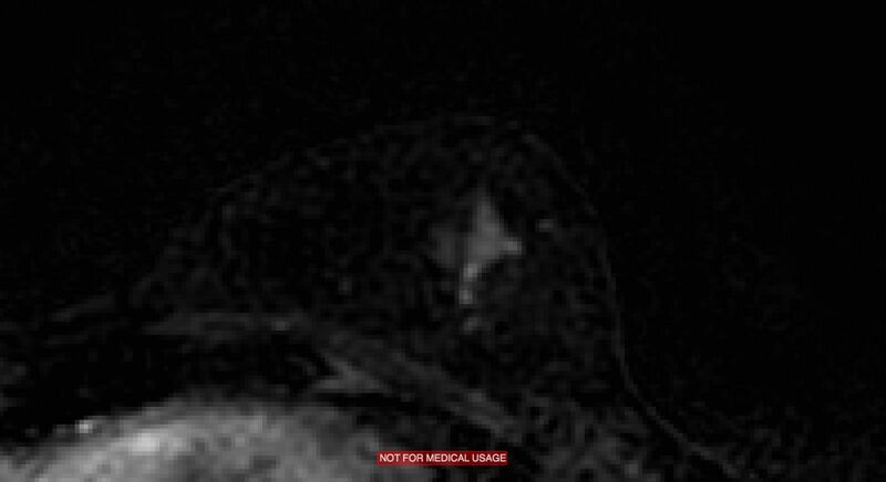File:Breast lymphoma (MRI) (Radiopaedia 34999-36498 C 18).jpg