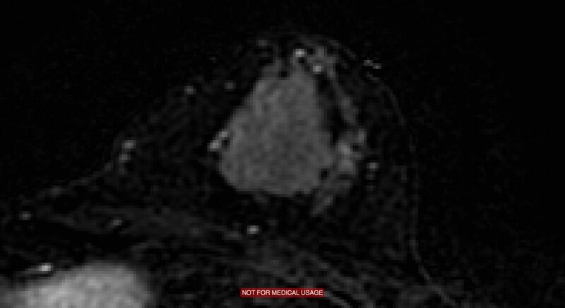 File:Breast lymphoma (MRI) (Radiopaedia 34999-36498 C 4).jpg