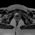 Broad ligament fibroid (Radiopaedia 49135-54241 Axial T2 24).jpg