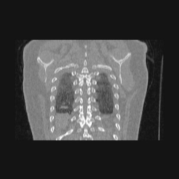 File:Bronchial atresia (Radiopaedia 60685-68439 Coronal lung window 9).jpg