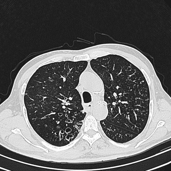 File:Bronchiectasis (Radiopaedia 22061-22059 lung window 10).jpg