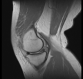 Bucket handle tear - medial meniscus (Radiopaedia 24900-25163 Sagittal T2 4).png