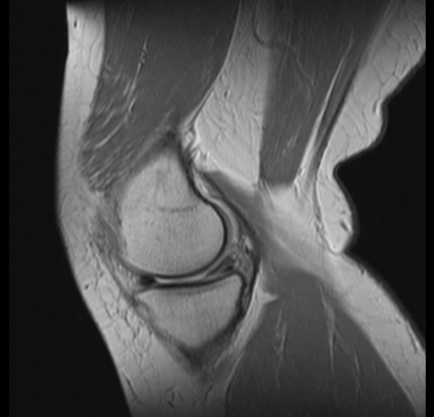 File:Bucket handle tear - medial meniscus (Radiopaedia 24900-25163 Sagittal T2 4).png