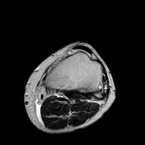 File:Bucket handle tear - medial meniscus (Radiopaedia 29250-29664 Axial T2 2).jpg