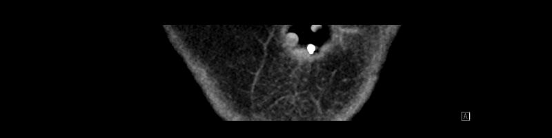 File:Buried bumper syndrome - gastrostomy tube (Radiopaedia 63843-72575 Coronal Inject 5).jpg