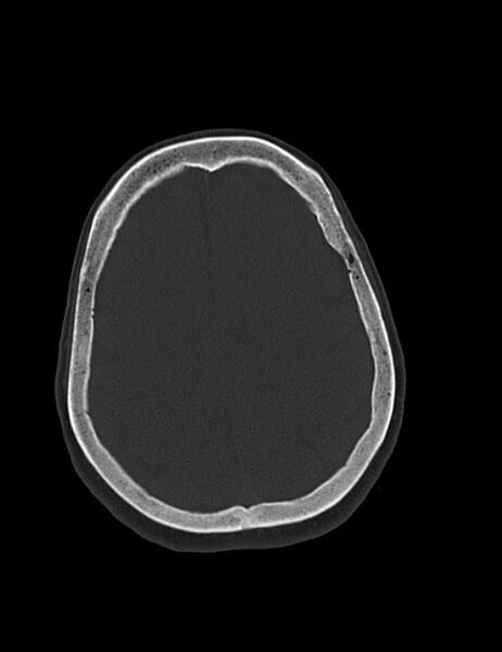 File:Burnt-out meningioma (Radiopaedia 51557-57337 Axial bone window 34).jpg
