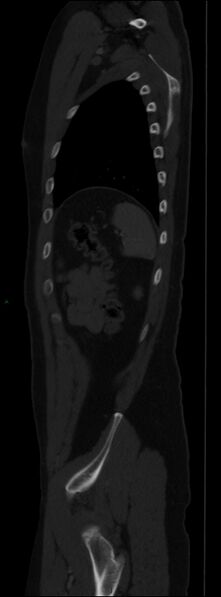 File:Burst fracture (Radiopaedia 83168-97542 Sagittal bone window 101).jpg