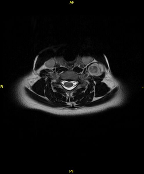 File:C5 nerve sheath tumor (Radiopaedia 85777-101596 Axial T2 44).jpg