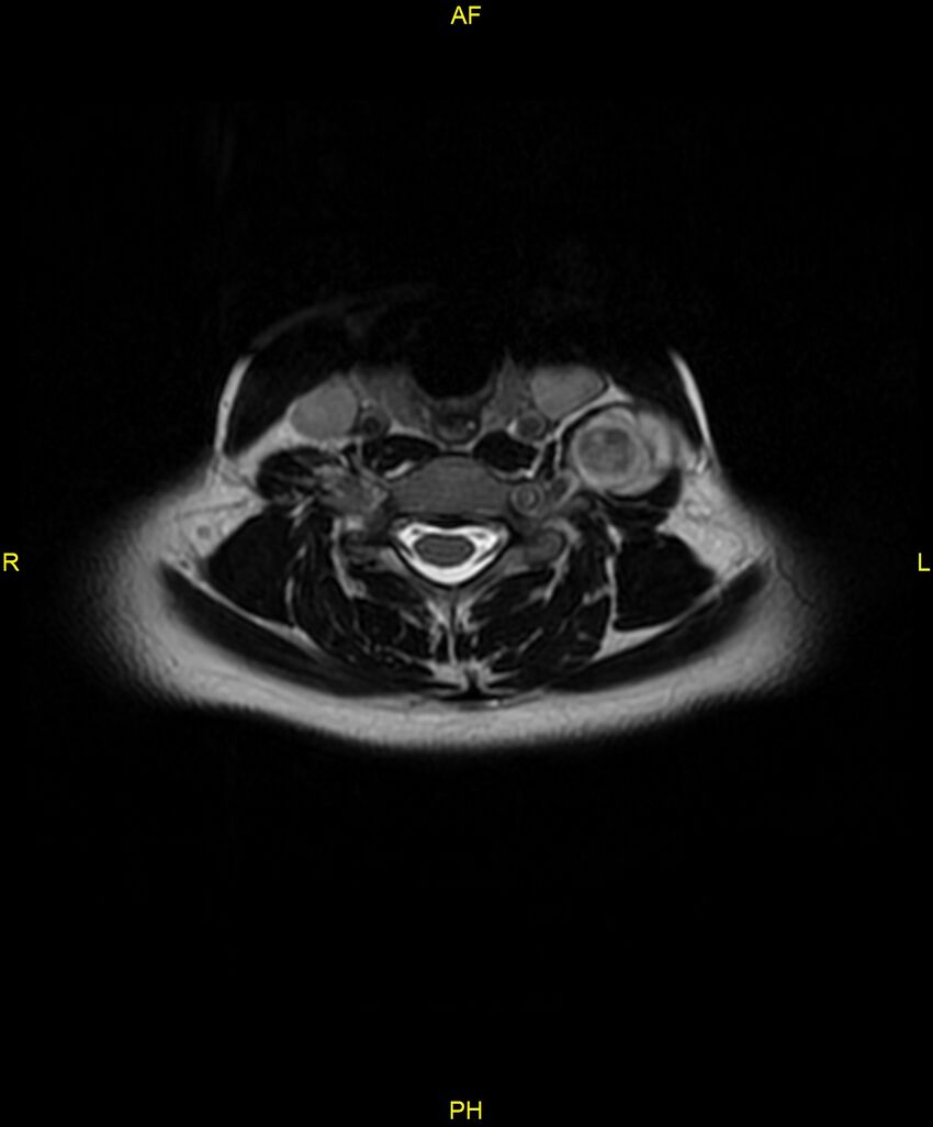 C5 nerve sheath tumor (Radiopaedia 85777-101596 Axial T2 44).jpg