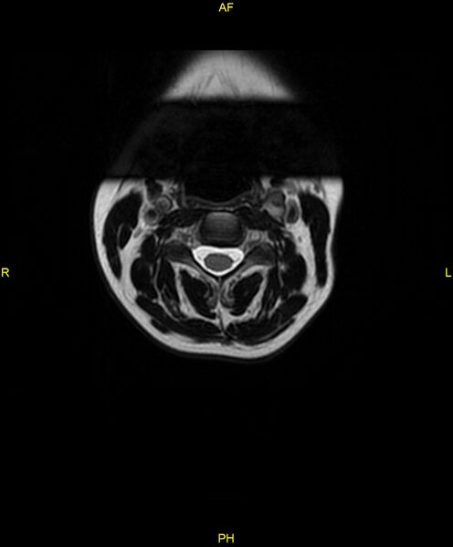 File:C5 nerve sheath tumor (Radiopaedia 85777-101596 Axial T2 8).jpg